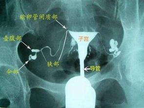 输卵管造影视频全过程,从准备到结果解读