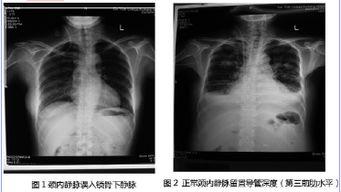 颈内静脉穿刺置管视频,颈内静脉穿刺置管操作步骤及要点解析